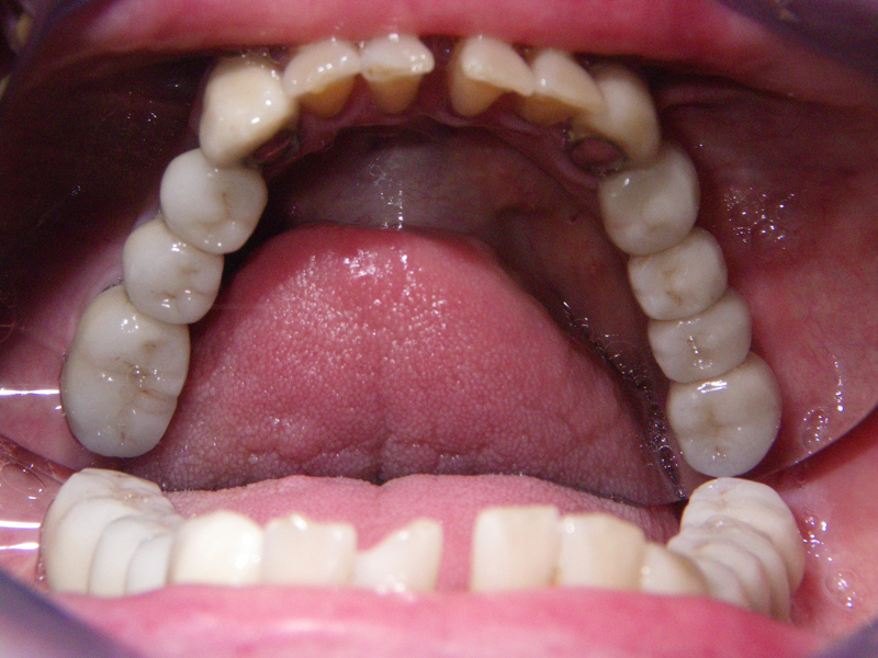 Dental Implants C.E. Solano, D.M.D Oral and Maxillofacial Surgery